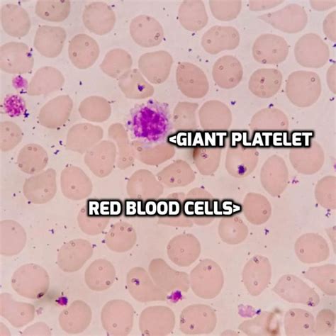 GIANT PLATELETS are the size of a normal red blood cell. Patients with ...