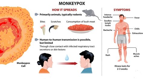 What is Monkeypox? - Civilsdaily