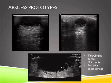 Skin Anatomy Ultrasound