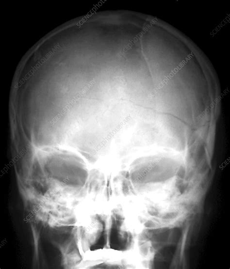 Skull fracture, X-ray - Stock Image - C040/3078 - Science Photo Library