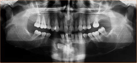 Odontogenic keratocyst (OKC) - radRounds Radiology Network