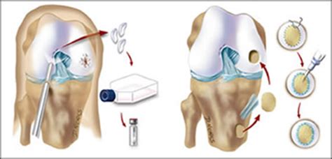 Cartilage Repair - Los Angeles, CA | C. Thomas Vangsness, Jr., M.D.