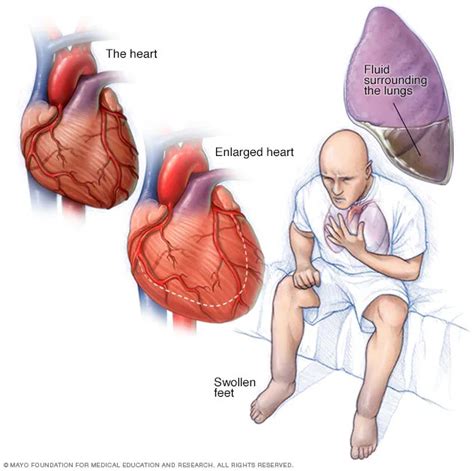 Heart Failure: Causes and Risk Factors - AIR-CLINIC