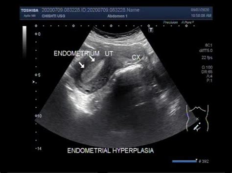 Ultrasound Video showing Two cases of Endometrial hyperplasia. - YouTube