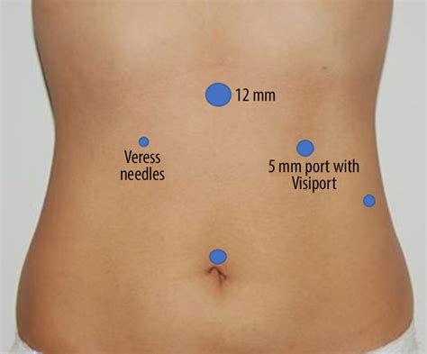 Laparoscopic Cholecystectomy Ports