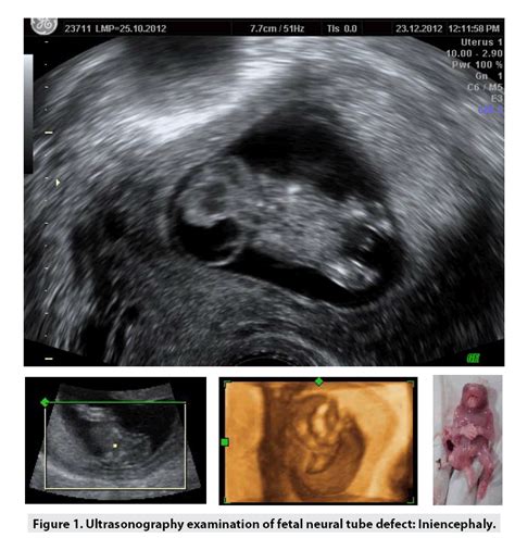 A rare case of a fetal neural tube defect: Iniencephaly