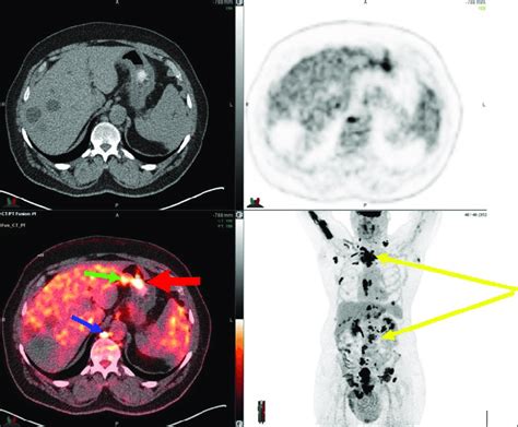 FDG PET/CT at 60 min: An intense focus of uptake in the retrocrural ...