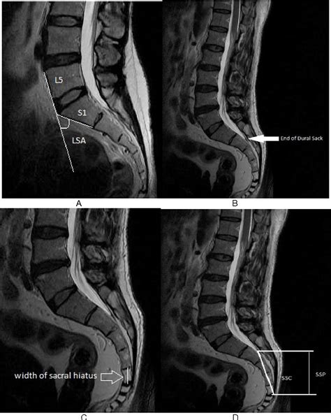 Figure I from Assessing the dimension of sacral spinal canal for thecaloscopy using MRI ...