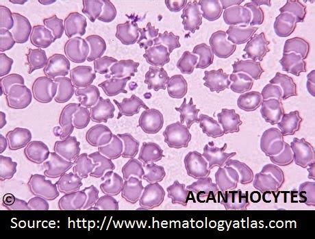 Lab Atlas: Acanthocytes