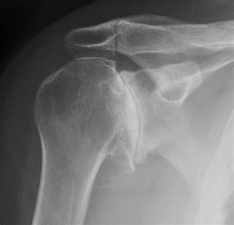 Shoulder Arthritis / Rotator Cuff Tears: causes of shoulder pain: Two X-rays for shoulder arthritis