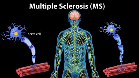 Early Signs And Symptoms Of Multiple Sclerosis. - Doctor ASKY