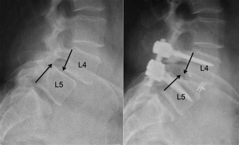 Spondylolisthesis Surgery Before And After