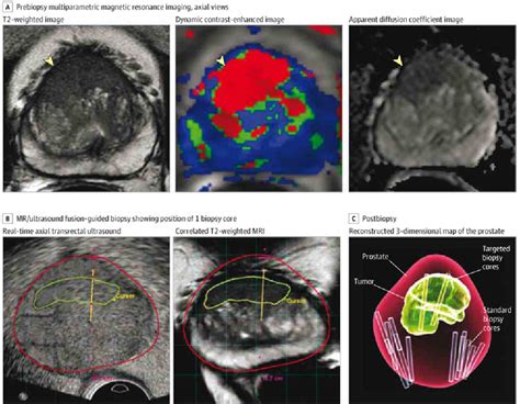 MRI Ultrasound Fusion Guided Biopsy | Semantic Scholar