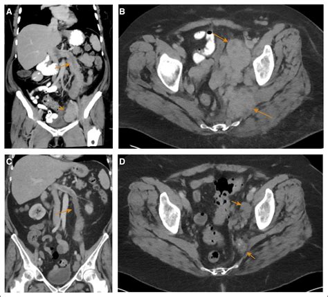 Treatment of Disseminated Intravenous Leiomyomatosis With ALK Targeting ...