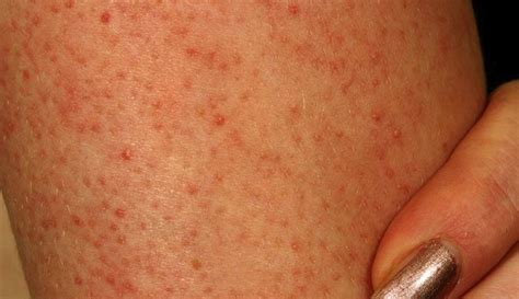 keratosis-pilaris-pictures-2 | Dorothee Padraig South West Skin Health Care