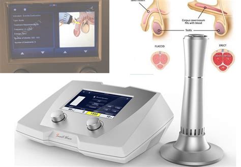 Low Intensity Shockwave Therapy (Lieswt) Ed Shock Wave Therapy ...