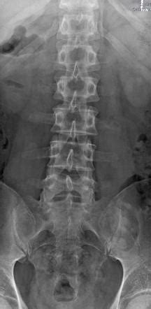 Ap Lumbar Spine Xray