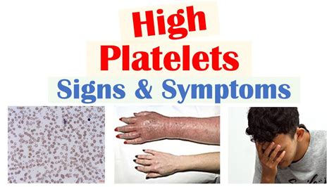 High Platelets (Thrombocytosis) Signs & Symptoms | Rapid Review - YouTube