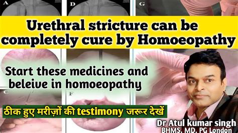 Urethral stricture treatment | Urethral stricture causes symproms & treatment | मूत्र नली में ...