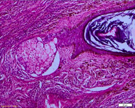 Congenital Melanocytic Nevus Histology