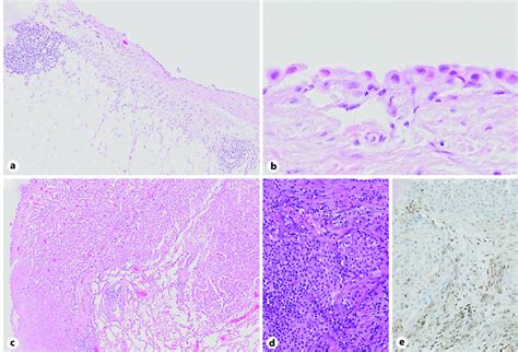 a Low-power view of the initial pleural biopsy being consistent with... | Download Scientific ...