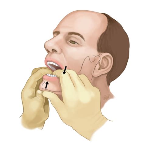 emDOCs.net – Emergency Medicine EducationCORE EM: Temporomandibular Joint (TMJ) Dislocation ...