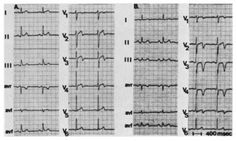 Wellens Syndrome • LITFL • ECG Library Eponym