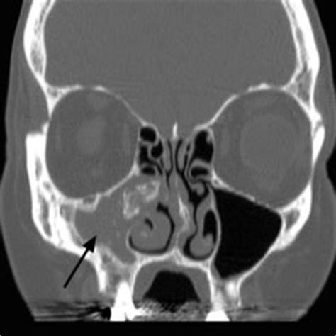 Fungus Ball - Raleigh Capitol Sinus & Allergy Center