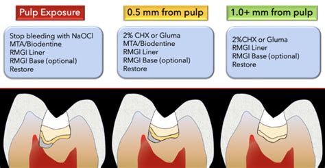 Indirect Pulp Capping - Atlas Dental