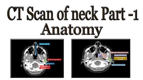 CT Scan of neck anatomy part 1 - YouTube