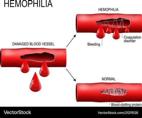 Hemophilia is coagulation disorder Royalty Free Vector Image