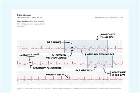 Accelerated Idioventricular Rhythm Vs. Premature Ventricular ...