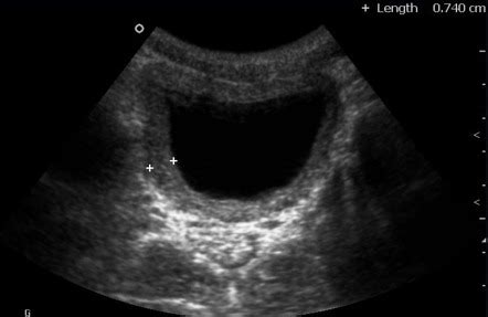 Bladder wall thickening (differential) | Radiology Reference Article ...