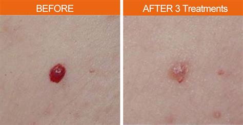 Cherry Angioma Removal Laser : Cherry Angioma Removal Hemangioma ...