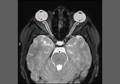 Idiopathic Intracranial Hypertension Mri