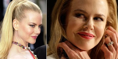 Nicole Kidman's face sparks conversation about Botox | WTOP