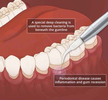 Gum Disease Treatment in Brooklyn NY - LuxDen Dental Center