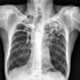 Initial bronchoscopic image showing with edematous, inflammatory... | Download Scientific Diagram