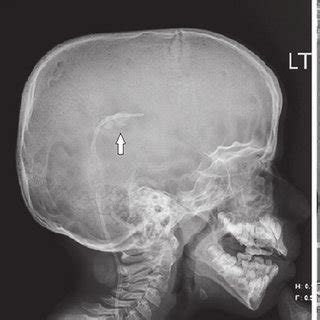 Plain X-ray shunt series. AP, anteroposterior. a AP skull Xray that ...