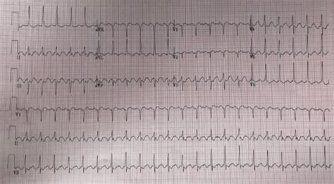 Characteristics of Typical Atrial Flutter - County EM