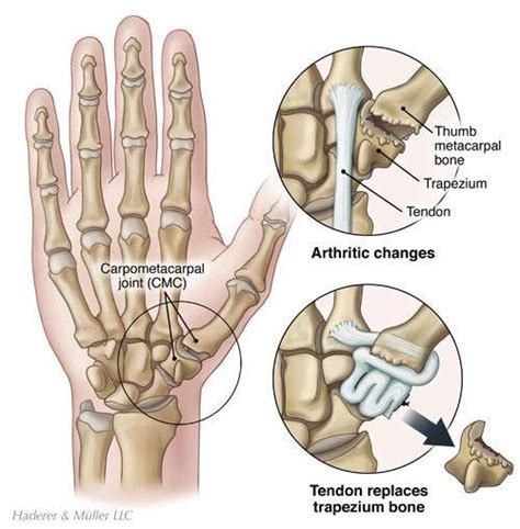 Thumb CMC (Basal Joint) Arthroplasty - Thumb Joint Reconstruction - Little Rock, AR & North ...