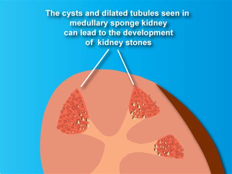 What is Medullary Sponge Kidney?