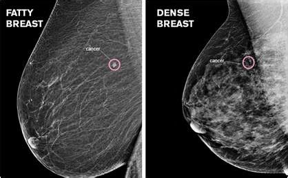 When a ‘normal’ mammogram result may not be ‘normal’