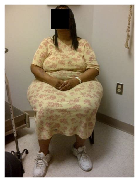 51-year-old black woman with BMI of 42.0 kg/m2 after bariatric surgery ...