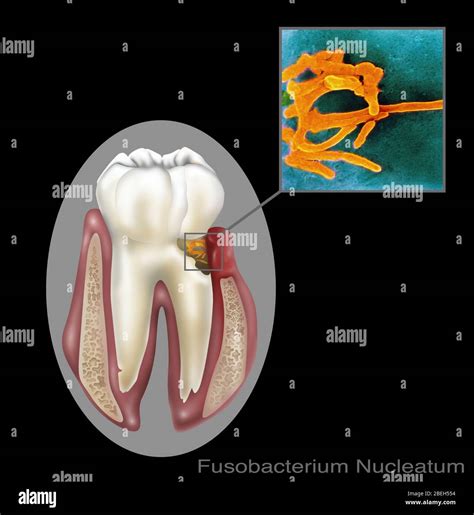 Oral Infection of Fusobacterium Nucleatum Stock Photo - Alamy