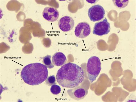 promyelocytes and blasts - Google Search | Hemoterapia, Células sanguíneas, Hemacias