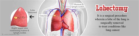 Lobectomy - Surgical Procedure: Types, Procedures & Complications