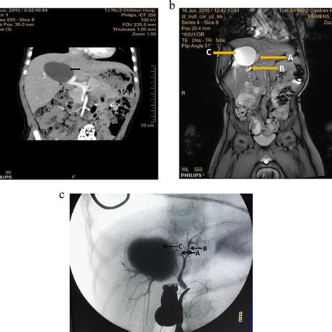 a. Roux-en-Y hepaticojejunostomy. b. Histopathology of right lobe of ...