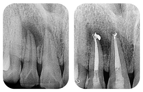 What is a Root Canal Treatment? - RCT - Twinkle Dental