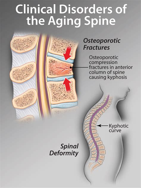 neurogenic claudication | HealthPlexus.net